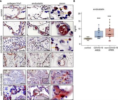 Basement membrane product, endostatin, as a link between inflammation, coagulation and vascular permeability in COVID-19 and non-COVID-19 acute respiratory distress syndrome